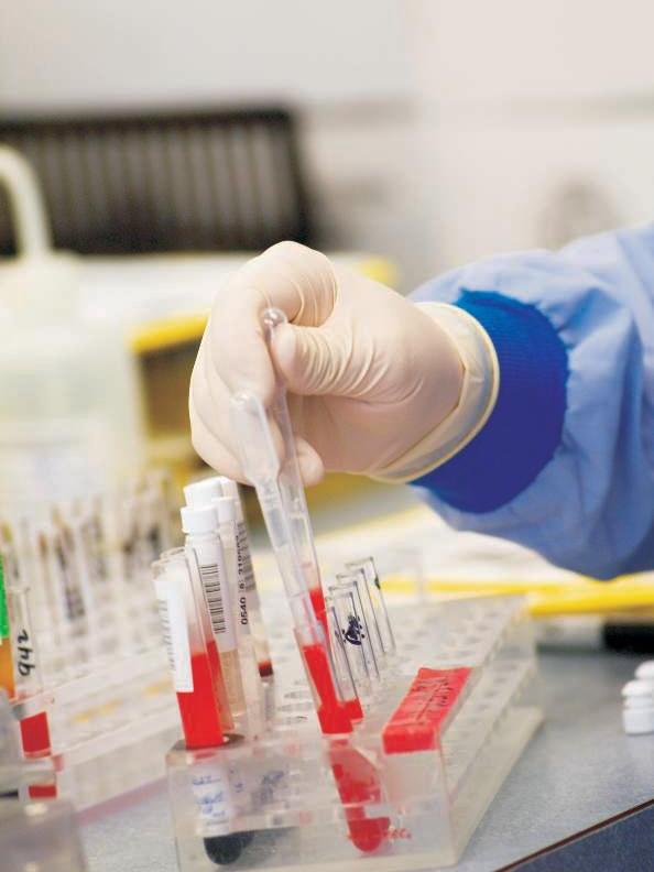 Serum Bilirubin