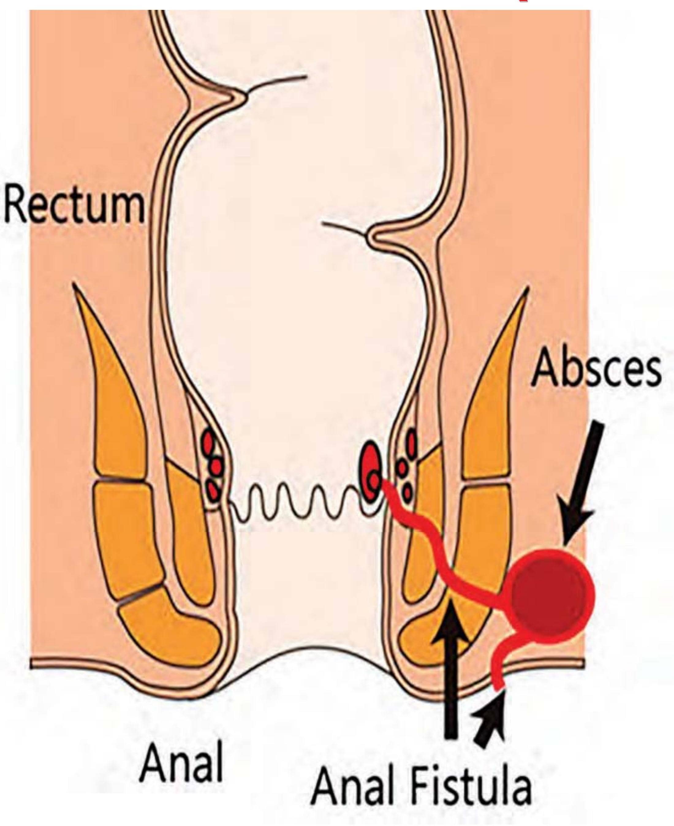 ન કહેવાય, ન સહેવાય એવો રોગ - ભગંદર (Fistula)