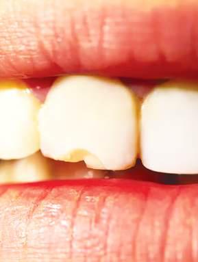 DON'T IGNORE A CHIPPED TOOTH: EXPERT ADVICE ON CARE AND TREATMENT