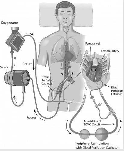 இதய, நுரையீரல் பொறி (ECMO)
