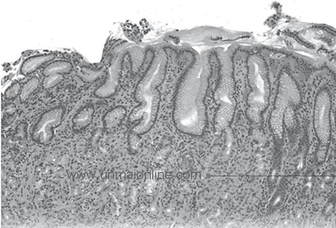 இரைப்பை அழற்சி (GASTRITIS)