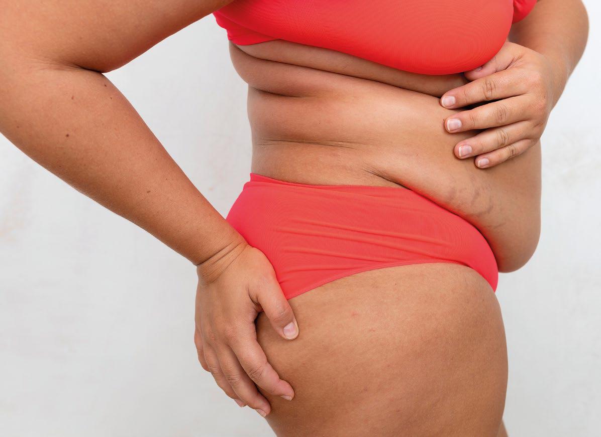 HOW TO GET RID OF AN APRON BELLY