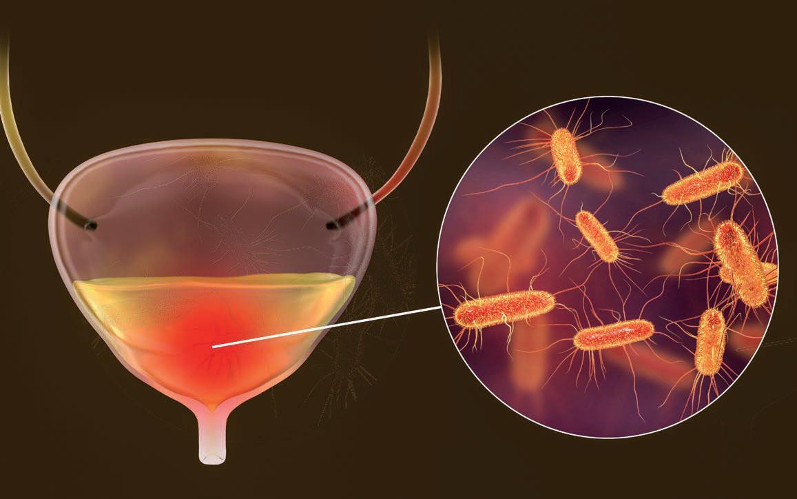 Infecciones urinarias de repetición tratadas desde la medicina integrativa con bioresonancia (esbia)