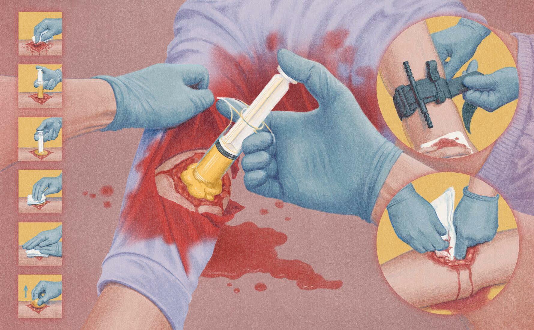 CRESILON: FOR STOPPING BLEEDING― QUICKLY