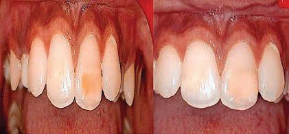 White Spot Lesions in Dentistry