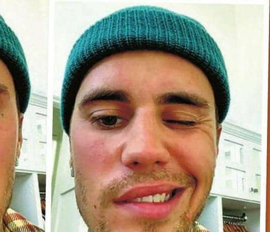 JUSTIN BIEBER'S FACE PARALYZED BY VICIOUS VIRUS
