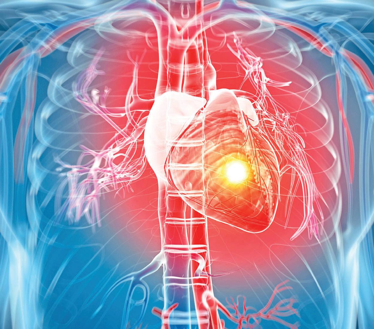 STROKE, CARDIAC RISK TIED TO VIRAL BUGS