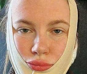 IRELAND BALDWIN: WHY I GOT A FACELIFT AT 26