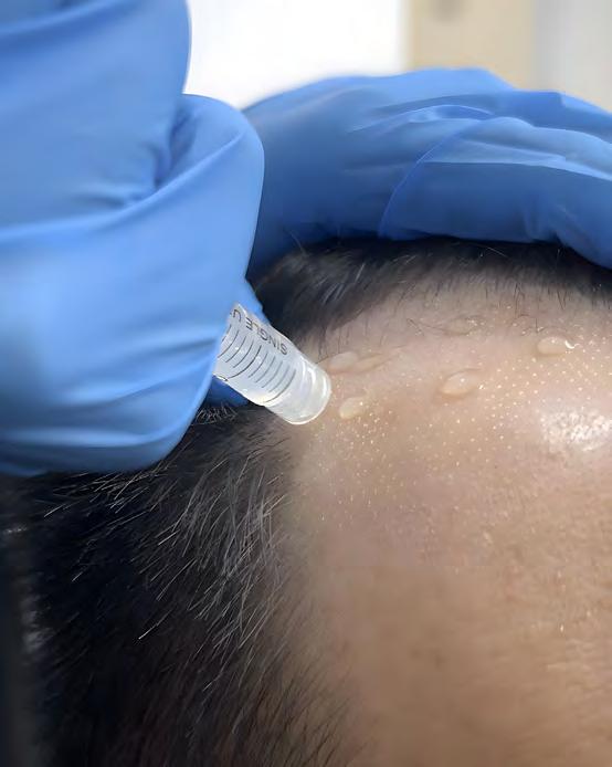 BEST TREATMENT FOR THINNING HAIR HAIR DOC ULTRA FOLLI X