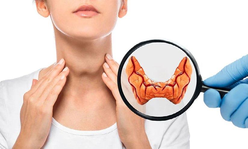 Thyroid Nodules