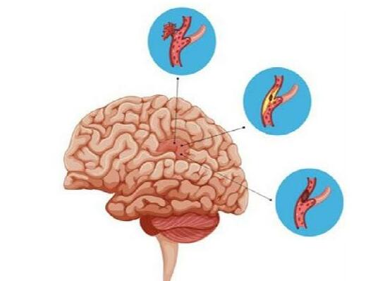 Crucial Aspects of Acute Ischemic Stroke: Management, Prevention, and Treatment Advances