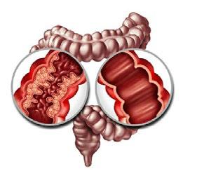 Rising tide of Inflammatory Bowel Disease in India