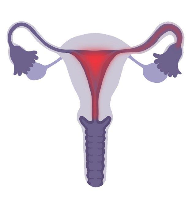 Pelvic Inflammatory Disease What Every Woman Should Know?