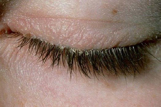 What Triggers Blepharitis and How Can You Prevent It?