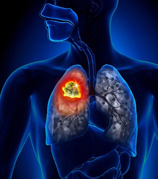 Understanding Lung Cancer Beyond Smoking
