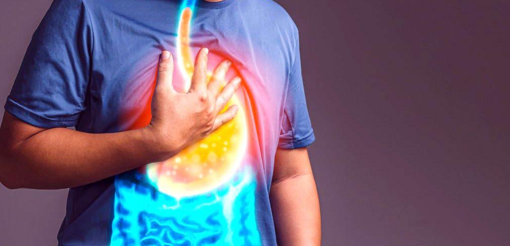 Gastroesophageal Reflux Disease (GERD)