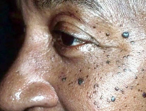 Why Seborrheic Keratosis Appears and How to Manage It