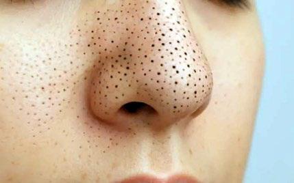 How to Get Rid of BLACKHEADS Naturally and Safely