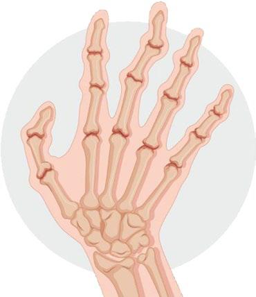 Autoimmune Arthritis
