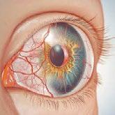 Steroid Overuse and the Silent Rise of Secondary Glaucoma