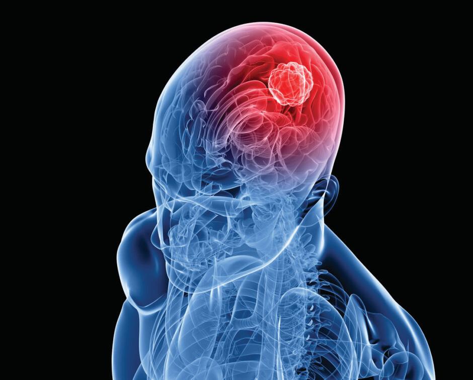CAUSATIVE FACTORS AND EARLY WARNING SIGNS OF BRAIN TUMOURS