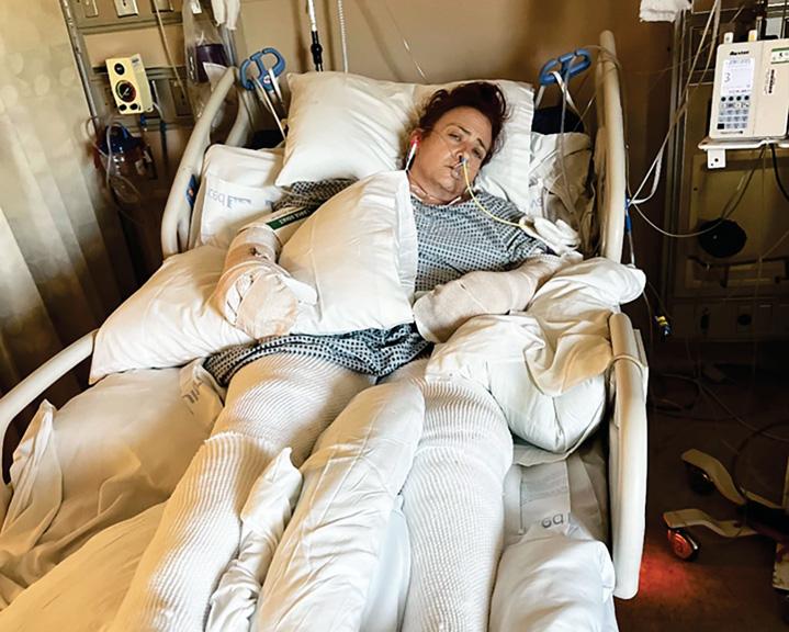 Night sweats Teft me SCARRED FOR LIFE