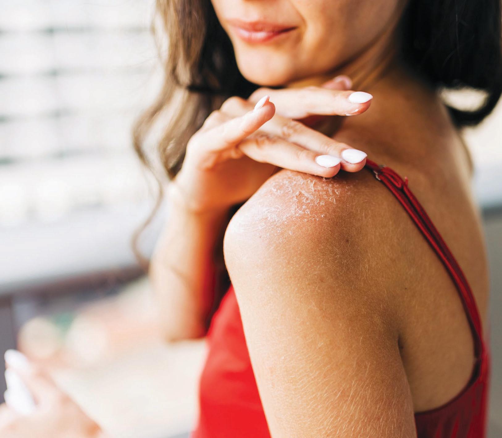 Soothe sunburn by tomorrow