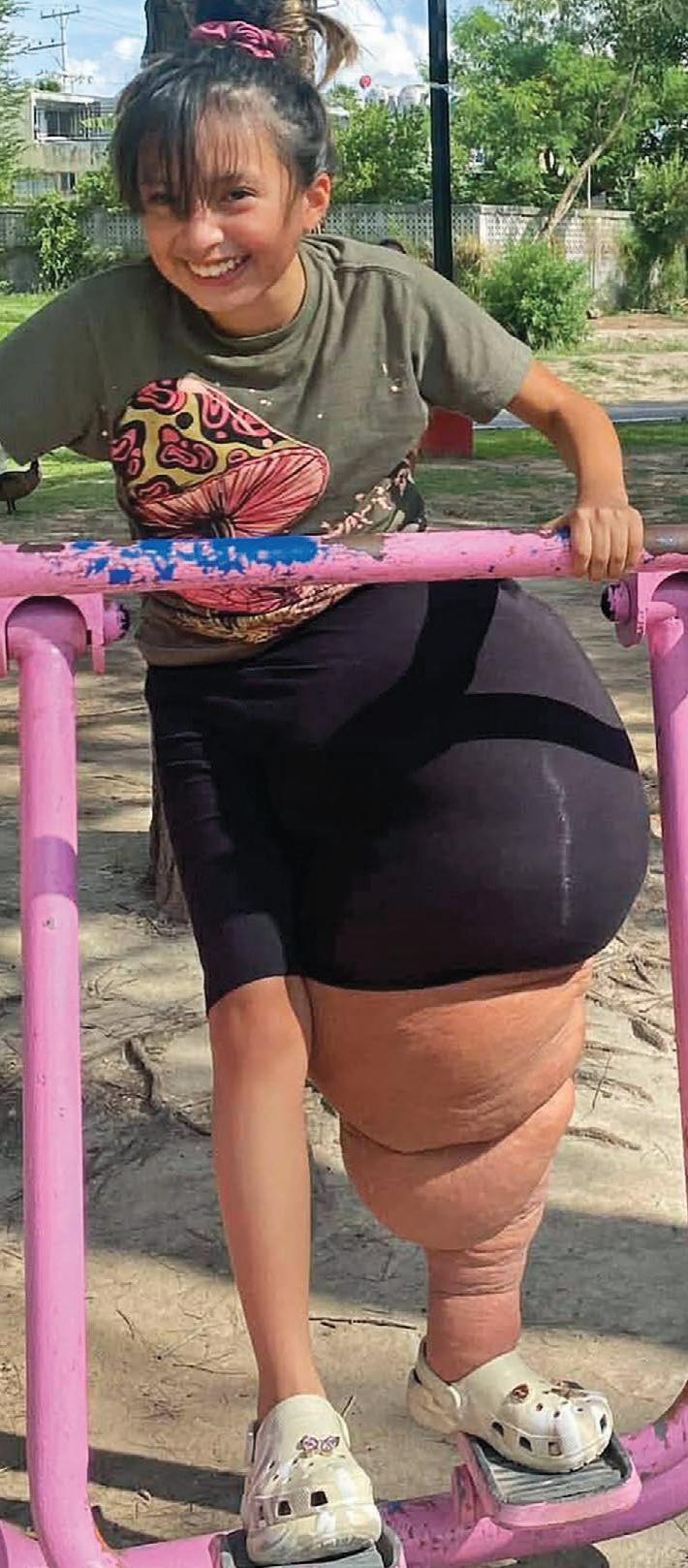 MY GIRL'S 12st LEG!