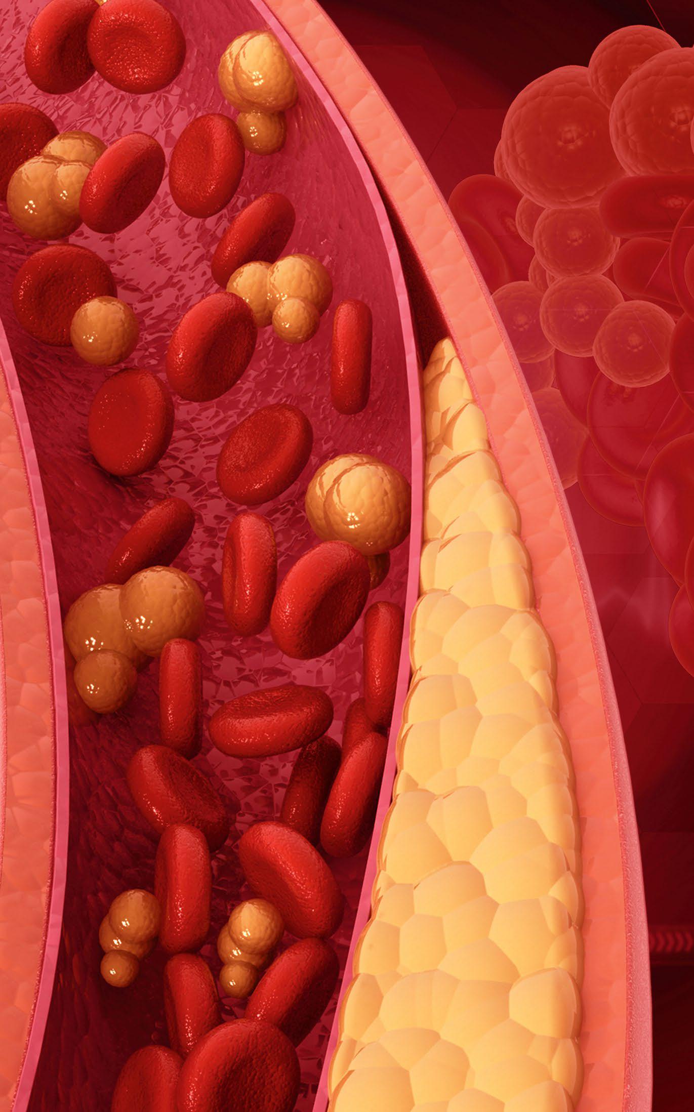 Coping with HIGH CHOLESTEROL