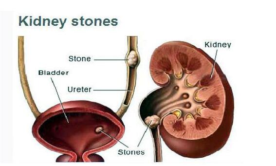 కిడ్నీలో రాళ్ళు కరగడానికి గృహ చికిత్స