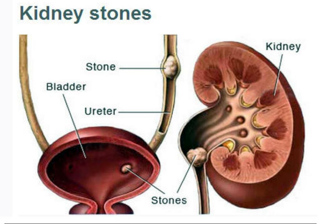 కిడ్నీలో రాళ్ళు కరగడానికి గృహ చికిత్స
