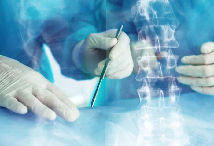 ENDOSCOPIC SPINE SURGERY: MAKING SPINE TREATMENT EASY AND AFFORDABLE