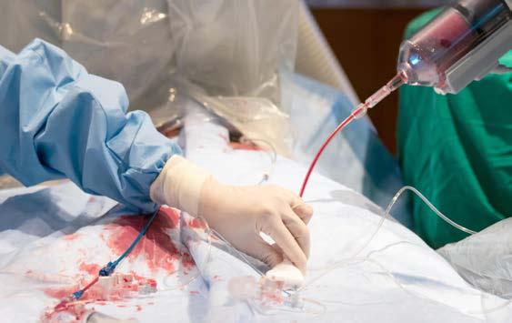 MANIPAL HOSPITAL GOA PERFORMS REGION'S FIRST ROTA-PRO ANGIOPLASTY ON 84-YEAR-OLD PATIENT
