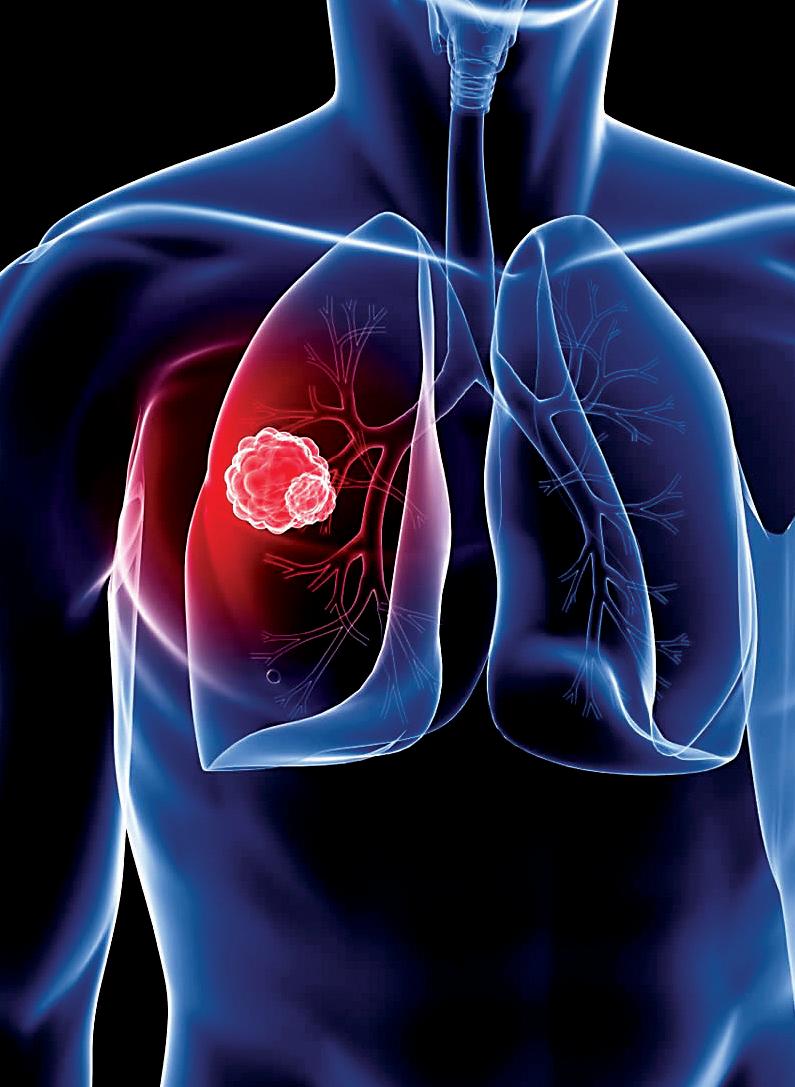 Johnson & Johnson Medtech partners with Qure.ai to boost early detection of lung cancer in India