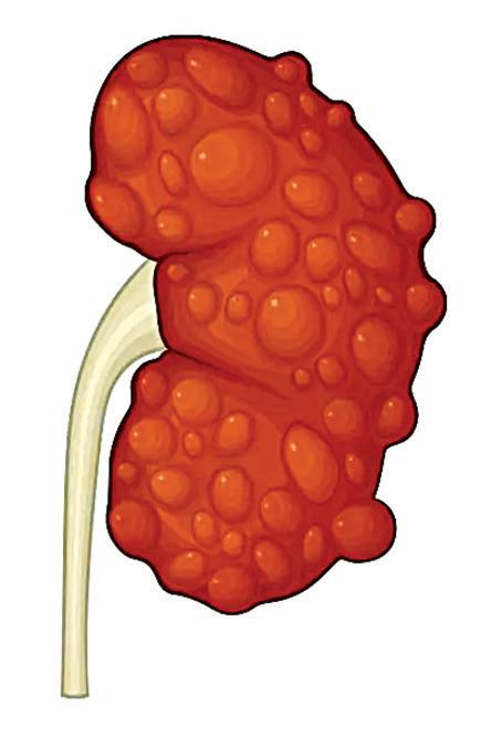 CUREator backs Monash biotech to advance new therapeutics for polycystic kidney disease