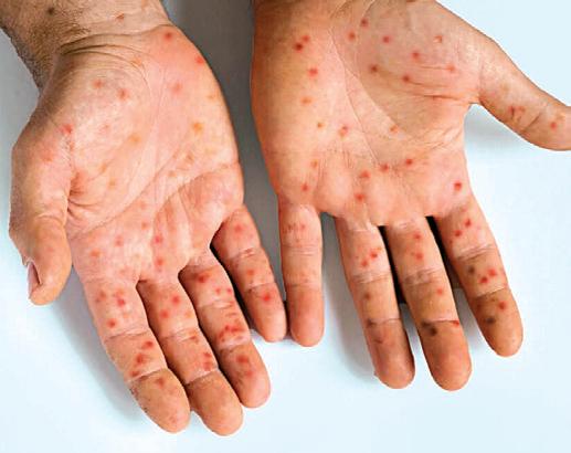 PAHO intensifies call to strengthen vaccination in light of rising measles cases