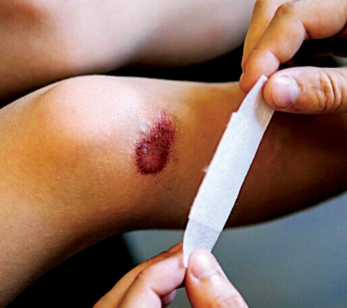 Singapore finds new way to restore healing in chronic wounds
