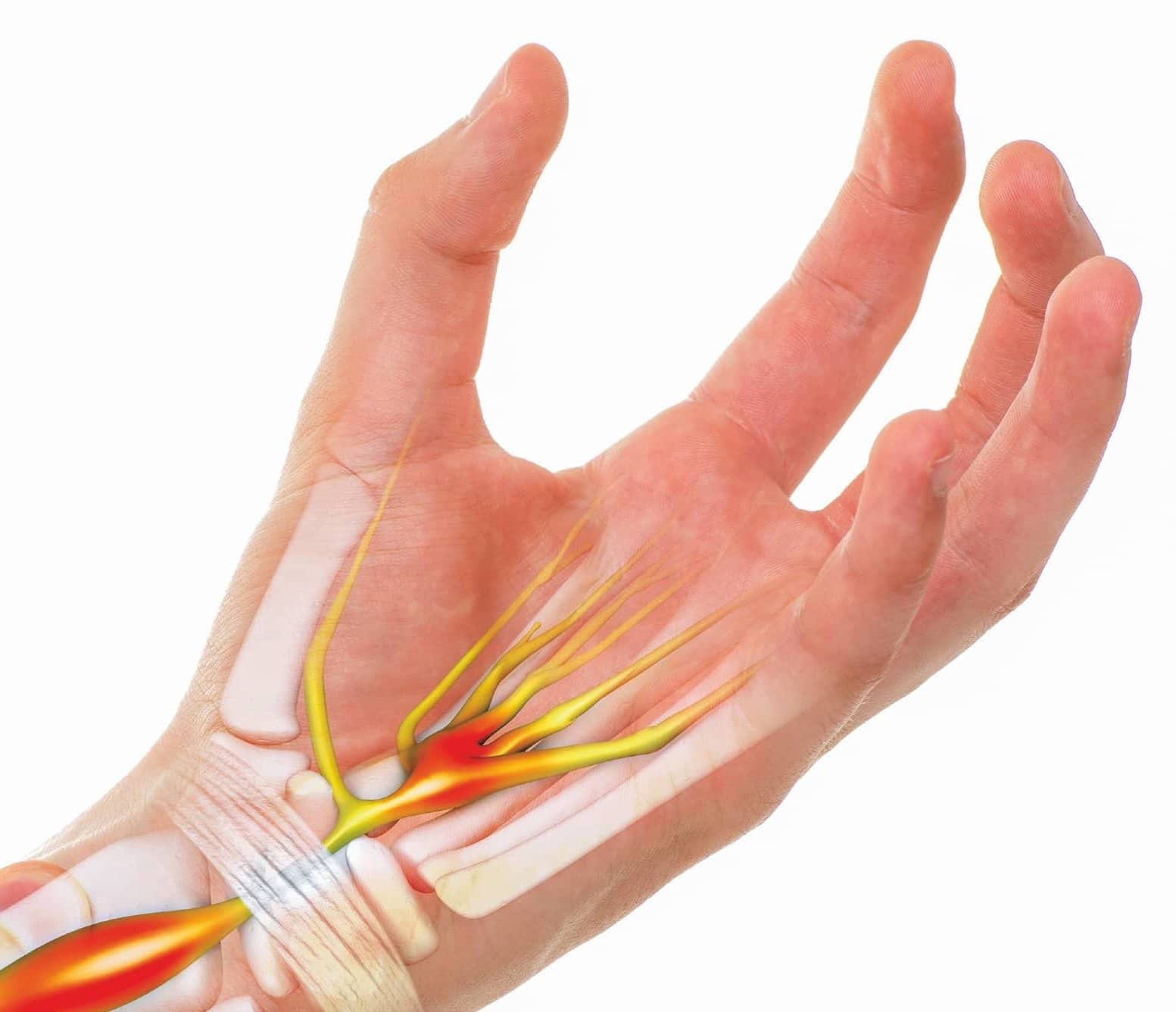 Carpal Tunnel Syndrome Caused By Work