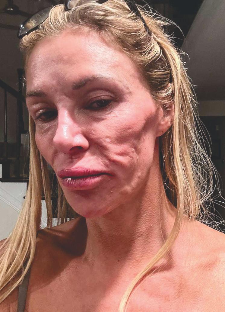 Brandi Finally Reveals Cause of Facial Parasite