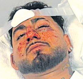 ‘Racist assault’ leaves Mohali man hospitalised in Australia