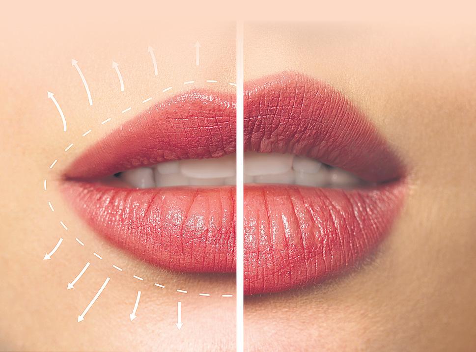 UORFI JAVED'S LIP FILLER REVERSAL: EXPERTS WEIGH IN