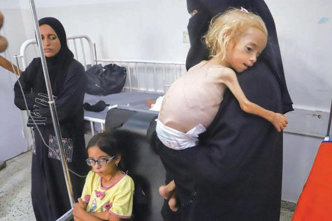 Protruding ribs proof of malnutrition: Doctors
