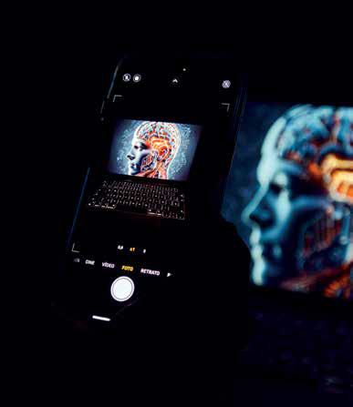 Brain Atrophy