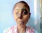 UP: Acid attack survivor receives Rs 5 lakh compensation after 28 years