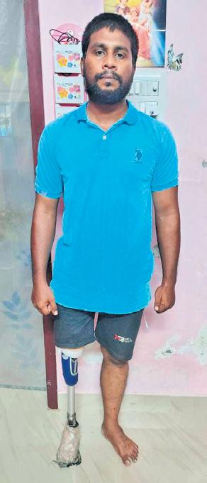 Man seeks help to maintain prosthetic leg as CM's insurance does not cover it