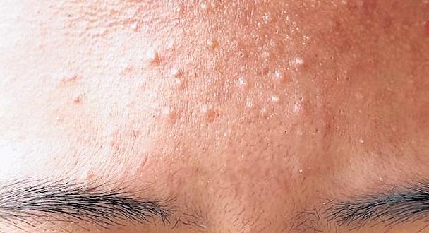 The rise of fungal acne across age groups