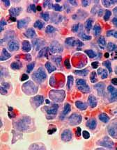 TAPPING YEAST TO SET CANCEROUS CELLS RIGHT