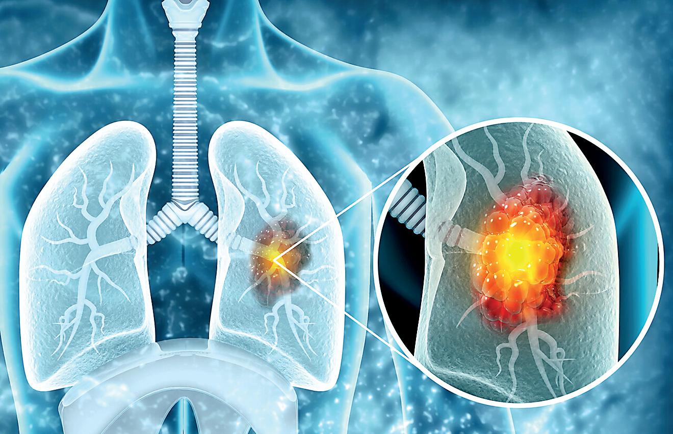 Non-smokers form large segment of people with lung cancer