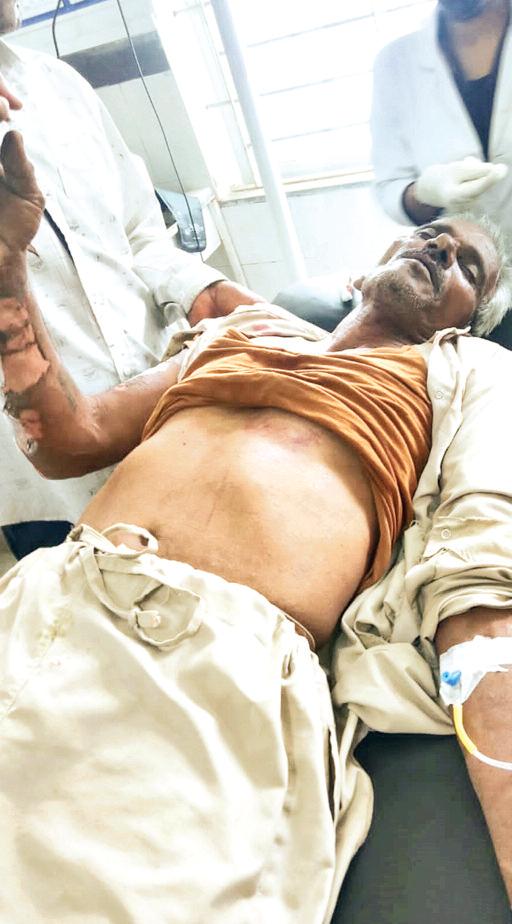 विद्युत लाइन पर कार्य करने के दौरान लाइनमैन झुलसा, जिला चिकित्सालय रेफर