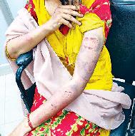 पति, सास व ससुर पर महिला को पीटने का आरोप बच्ची को बाल घसीटा, पत्नी के शरीर 15 जगह काटने के निशान